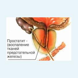 Хронический простатит: причины, симптомы и способы лечения