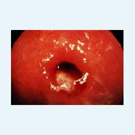 Цервицит острый и хронический
