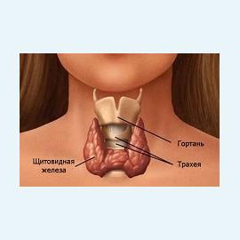 Узловой зоб щитовидной железы как причина бесплодия
