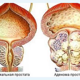 Увеличение предстательной железы