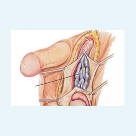 Варикоцеле - что делать?