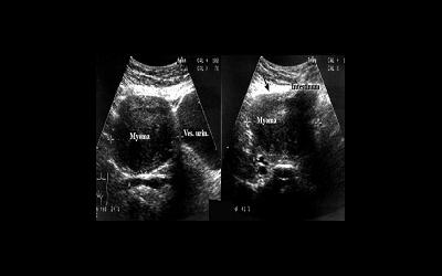 Ультразвуковое обследование при миоме матки