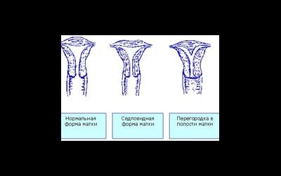 Аномалии матки