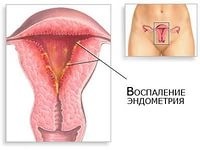 Эндометрит: что это такое?