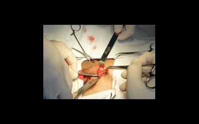 Операции при варикоцеле как метод лечения бесплодия