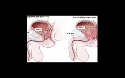 Хронический простатит и нарушенное семяизвержение: есть ли связь?
