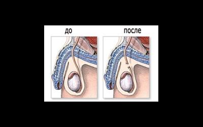 вазэктомия что это для женщины. Смотреть фото вазэктомия что это для женщины. Смотреть картинку вазэктомия что это для женщины. Картинка про вазэктомия что это для женщины. Фото вазэктомия что это для женщины