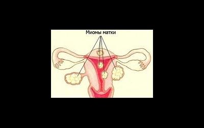 Эффективное лечение миомы матки