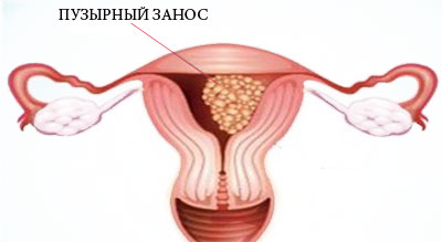 Внематочная беременность: симптомы, диагностика, лечение